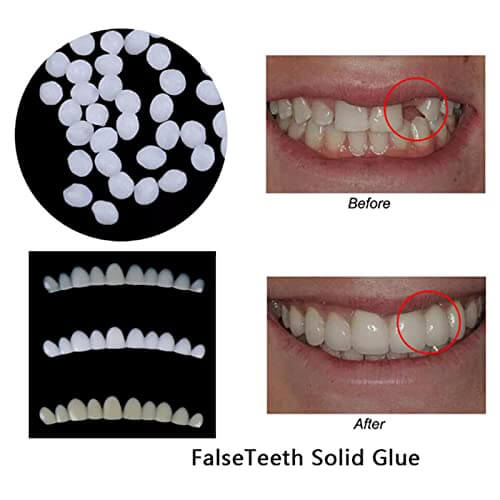CALANDIS® Moldable Teeth Veneers with Adhesive Fitting Beads – Temporary False Teeth Kit