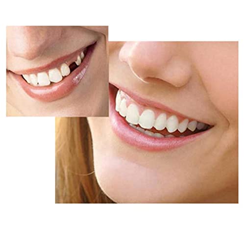 CALANDIS® Moldable Teeth Veneers with Adhesive Fitting Beads – Temporary False Teeth Kit