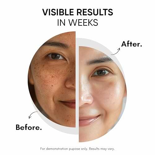 Dark Spot Reduction Cream for Pigmentation, Melasma & Acne Marks with Kojic Acid & Alpha Arbutin – For Men & Women (50g)