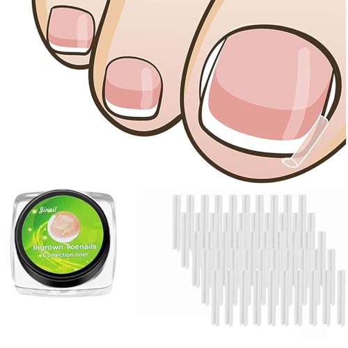 Toenail Corrector Strips – Ingrown Nail Corrector with Gentle Adhesive (50 Pcs Breathable Patches)