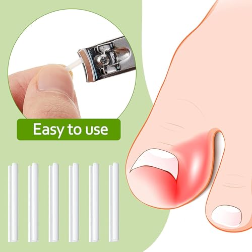 Toenail Corrector Strips – Ingrown Nail Corrector with Gentle Adhesive (50 Pcs Breathable Patches)
