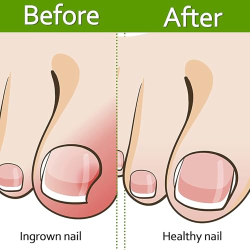 Toenail Corrector Strips – Ingrown Nail Corrector with Gentle Adhesive (50 Pcs Breathable Patches)